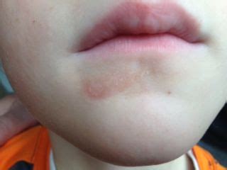 And they can occur in one area of skin or all over the body. Early Stage Lip Licker's Dermatitis: Rash around the lips ...