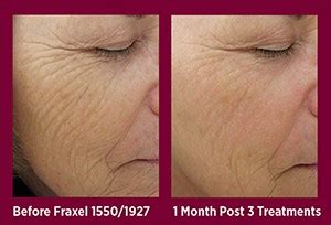 Contact serving men and women for over 30 years, we are the triad's premier center for advanced hair removal procedures and specialty skin rejuvenation. Fraxel® Dual - Advanced Laser & Skin Rejuvenation
