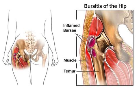 But having the barbell in front of you allows you to maintain a more upright torso, freeing up space in your hips, and allowing you to sink even deeper into your squat. How to Sit with Lower Back or Hip Pain - Office Solution Pro