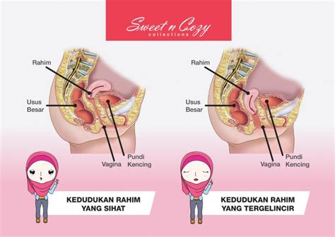 Dengan terhalangnya laluan ini, sperma tidak dapat bersenyawa dengan telur. Wanita Perlu Tahu Cara Sebenar Kesan Peranakan Jatuh ...