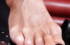 feet mature toenails