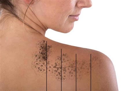 Costs less than one laser treatment. LASER Tattoo Removal - Best Skin Care And Laser Clinic in ...