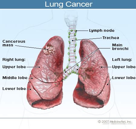 Stage 3a lung cancer either means the cancer is up to 5cm in size and has spread to the lymph nodes in the centre of the chest on the same side as the tumour. Keeping it Simple (KISBYTO): Lung Cancer Awareness Month