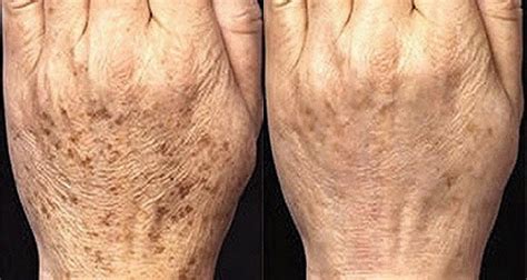 Grafis tangan jantung logo, menjamur tangan, cinta, tangan png. Hapus Keriput Dan Bintik-Bintik Di Wajah, Tangan Dan ...