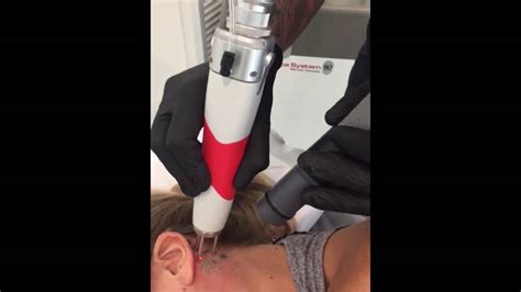 Here you can watch laser tattoo removal being performed. Lazco Tattoo Removal - Neck Tattoo Removal - YouTube