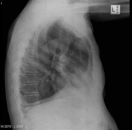 Maybe you would like to learn more about one of these? Mesothelioma | Image | Radiopaedia.org