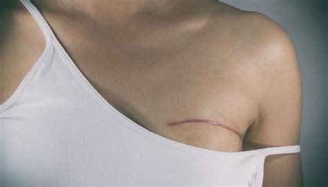 Breast cancer is the presence of malignant breast nodule, mass or abscess. Institutional racism to blame for lower breast cancer ...