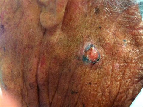 Tumori cutanei: screening e diagnosi precoce |Sardegna ...
