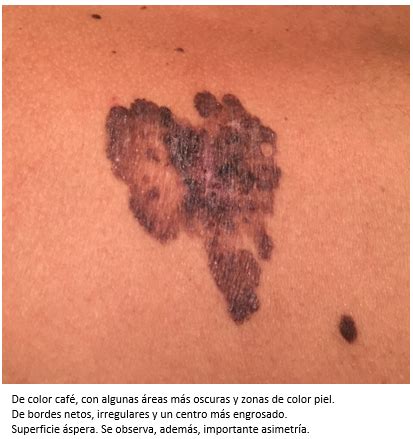 Carcinoma de células basales pigmentado simulando un ...