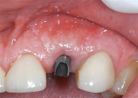 It is going to cost me around $20k. Our Dental Implants - Bonacci Periodental Implants