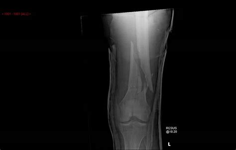 Distal femur fractures are fractures including condyles of femur or in supracondylar region which mainly occur in young but also seen in older population. Distal Femur Fractures - Trauma - Orthobullets