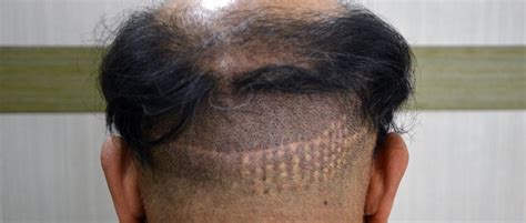 You can ruffle it with your hands. Don't get suckered by a BAD Hair Transplant! Part 2 - Bald ...