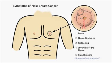 As the gynecomastia condition enters into the next stage, there will be a development of moderate breast enlargement without the development of excess skin. Male Breast Cancer: The Disease No One's Talking About