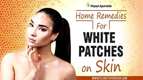 Following are some natural home remedies for white patches on skin. #Home #Remedies for #White #Patches on #Skin (#Vitiligo) # ...