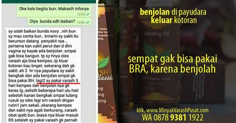 Faktanya, tidak semua benjolan payudara berbahaya. 5HARI KEMPES, Terapi Benjolan di Payudara Kempes, Sempat ...