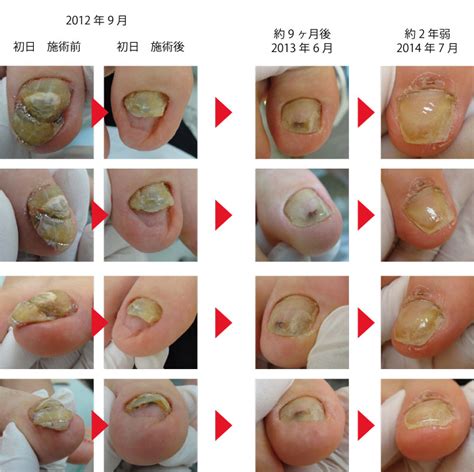 変形爪の修復 [田辺市で腰・肩・ひざの痛み治療なら楠本整骨 ...