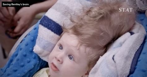 Baby Born With Brain Outside Skull - Baby With Birth ...
