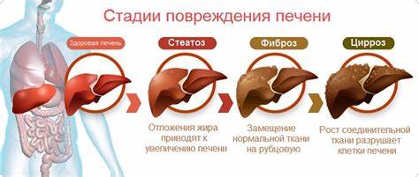 Жировой гепатоз симптомы лечение диета Cтеатоз печени – симптомы, лечение Cтеатоз печени – симптомы, лечение Жировой гепатоз симптомы лечение диета