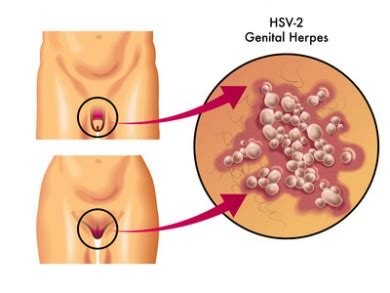 Alles wichtige über die ansteckende viruserkrankung. Genitalherpes (Herpes genitalis) - Ursachen, Beschwerden ...