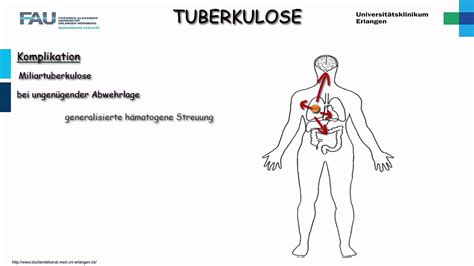 Die tuberkulose stellt in entwicklungsländern ein großes gesundheitspolitisches problem dar. Pathologie ─ Tuberkulose - YouTube