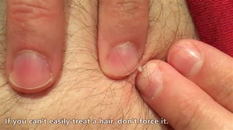 They are painful, but the most annoying part is trying to figure out how to get rid of ingrown hairs. Ingrown Hair! How to Remove Ingrown Hair! - YouTube