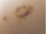 It is about 1 1/2 inches in diameter. What does a yellow bruise on the breast mean?