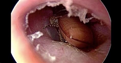 Nothing can be done unless we are given more information. Another Cockroach Gets Stuck In Someone's Head (Ew ...