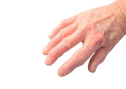 Eine finger arthrose in der hand kann gelenkverbindungen zwischen elle und speiche, speiche der gelenkverschleiß tritt hier zwischen den zwei handwurzelknochen kahnbein (skaphoid) und. Fingerendgelenksarthrose - Heberden-Arthrose | Hyaluronwelt