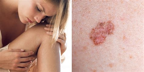 Cancer is a group of diseases involving abnormal cell growth with the potential to invade or spread to other parts of the body. 10 Signs of Skin Cancer You Shouldn't Ignore | SELF