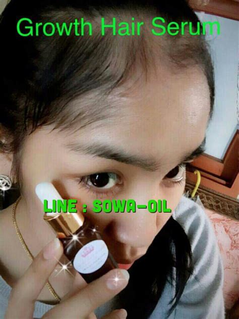 review biowoman magic hair serum หยดเดียวผมสวยทั่วไทย i by ausanisa chaiejuntra. เซรั่มปลูกไรผม บอกลาปัญหาหน้าผากกว้าง คิ้ว หนวดเครา ! - Pantip