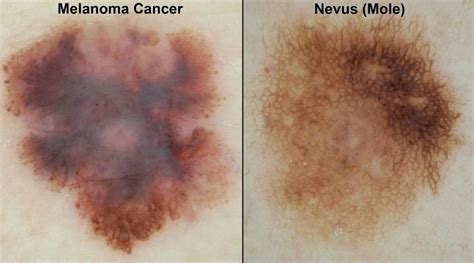 Tubuh lalat terdiri atas tiga bagian. 7 Ciri Orang yang Rentan Terkena Melanoma, Kanker Kulit ...