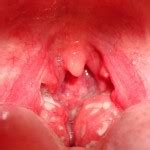 A lump in the mouth, throat or neck; Symptoms and Pictures of Throat Cancer | MedGuidance