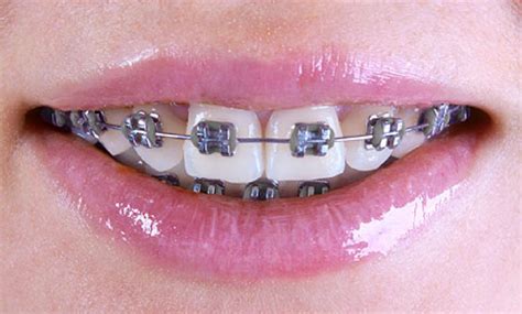 Appareil fixe multiattache - Clinique Orthosmile