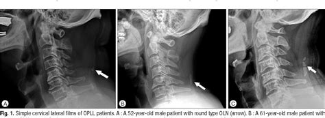 The ligamentum nuchae is a ligament that forms a strong, fibrous median partition between the muscles of the two sides of the back of the neck. Figure 1 from The Clinical Significance of Ossification of ...