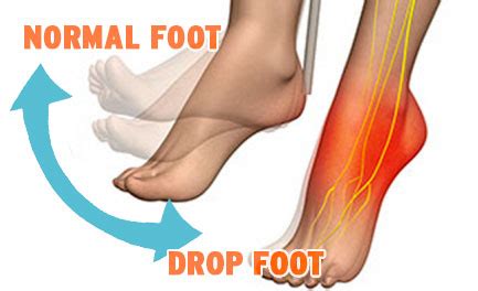 Foot Drop Specialist Clinic | Singapore Sports Clinic