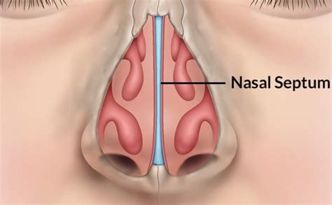 Septum nasi) separates the left and right airways of the nasal cavity, dividing the two nostrils. Complications of Untreated Deviated Nasal Septum