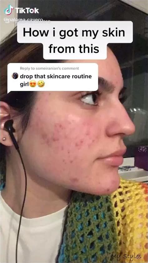Minimal moisturizer use is fine on very dry skin that needs hydration but try and avoid. Are you struggling with cystic or fungal acne that will ...