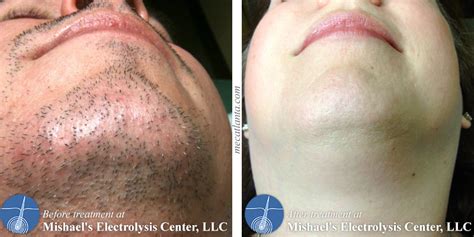 Darker than the color of the skin. Before & After Electrolysis Hair Removal | Mishael's ...