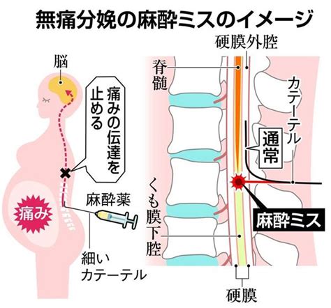 浅田 梨絵、今泉 和則 広島大学 医歯薬学総合研究科 doi：10.14931/bsd.821 原稿受付日：2012年3月21日 原稿完成日：2014年2月20日 担当編集委員：漆谷 真（滋賀医科大学 医学部 脳神経内科）. 無痛分娩死亡、きょう書類送検 業務過致死容疑で院長 麻酔ミス ...