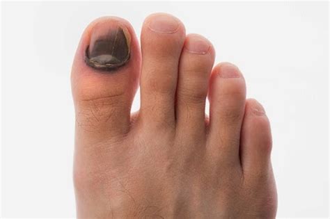 Tangan menjadi salah satu anggota tubuh yang kita gunakan setiap hari. Kuku Cantik Alami: Cara Mengobati Kuku Kaki Tangan Yang ...