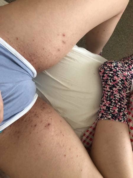 Pubic hair does a lot of protective work, keeping dirt and bacteria at bay and protecting the genitals. Ingrown hairs on bikini line | Mumsnet