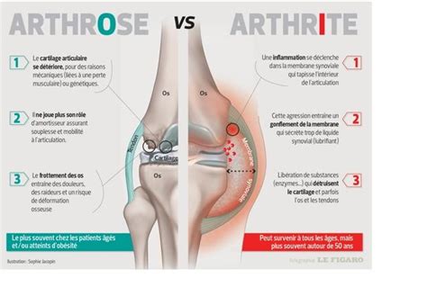 Les ménisques du genou (internes et externes) sont des cartilages qui rendent l'articulation la plus le médecin confirmera son diagnostic en présence des symptômes évocateurs et de mise en. Arthrose ou arthrite : pourquoi faut-il les distinguer