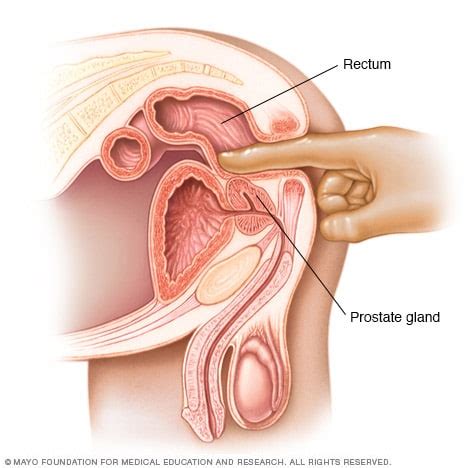 Prostate cancer in its early stages has no symptoms. Prostate cancer - Diagnosis and treatment - Mayo Clinic