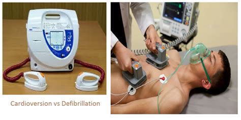 Principle of defibrillator defibrillator vs cardioversion principle and working of pacemaker anesthetic implications functioning of icd anesthetic implications of icd. Cardioversion vs Defibrillation - StudyPK