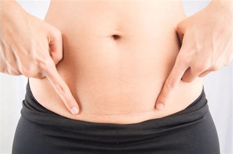 When you're cleared for exercise, add cardio and strength training exercises to burn fat. 15 Ways to Get Rid of Belly Fat After C-Section Delivery