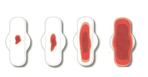 Swapna kollikonda, md, seorang spesialis obgyn mengatakan bahwa alasan mengapa warna darah haid berbeda dikarenakan warna darah haid bergantung pada berapa lama darah berada di dalam rahim dan vagina. Darah haid banyak: Punca, Simptom dan Rawatan - The Diagnosa