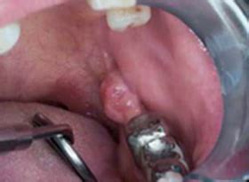 Therefore, individuals with questionable lesions on their cheeks should ask a dentist what oral cancer looks like in the mouth on the cheek? Oral Cancer Images - The Oral Cancer Foundation
