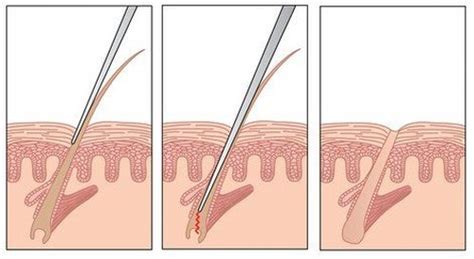 Electrolysis is a tried and tested method of hair removal and hair reduction that has been giving clients results since 1875. 10 Most Popular Hair Removal Solutions - Smashing Tops