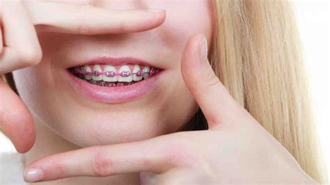 I personally never restrict my braces patient to eat anything as such.i do instruct them to eat everything in pieces as possible.avoid biting/ chewing as dentists we advice you to eat softer foods and avoid junk because it is easier to start with softer foods during your initial period of time when you get braces. Launch Your Spring with Braces