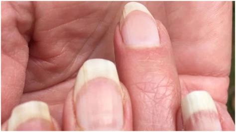 Maybe you would like to learn more about one of these? covid 19 symptoms check your hands for covid nails in the ...